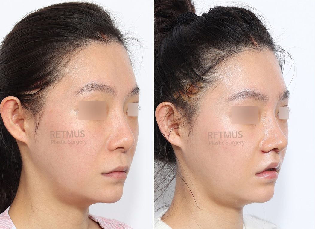 인중코 1주차 [인중축소+코재수술] (upper lip lift + Revision Rhinoplasty)