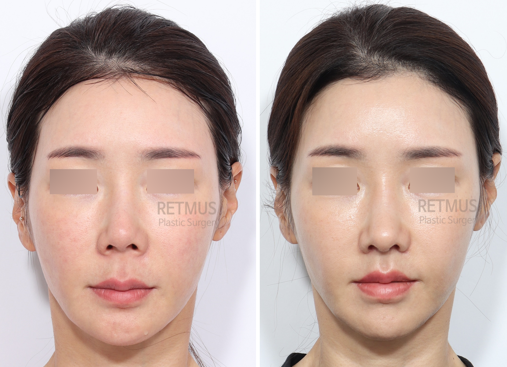 인중코 1개월차 [인중축소+코끝재수술] (upper lip lift+ tip revision)