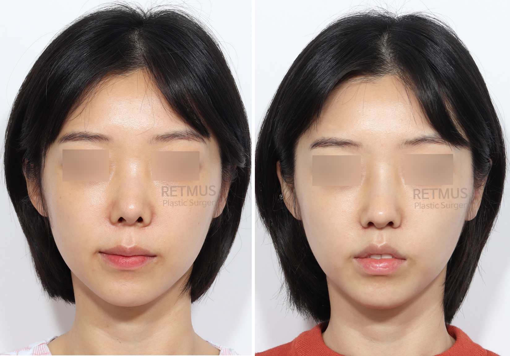 인중코 1개월차[인중축소+코끝재수술] (upper lip lift + tip revision)