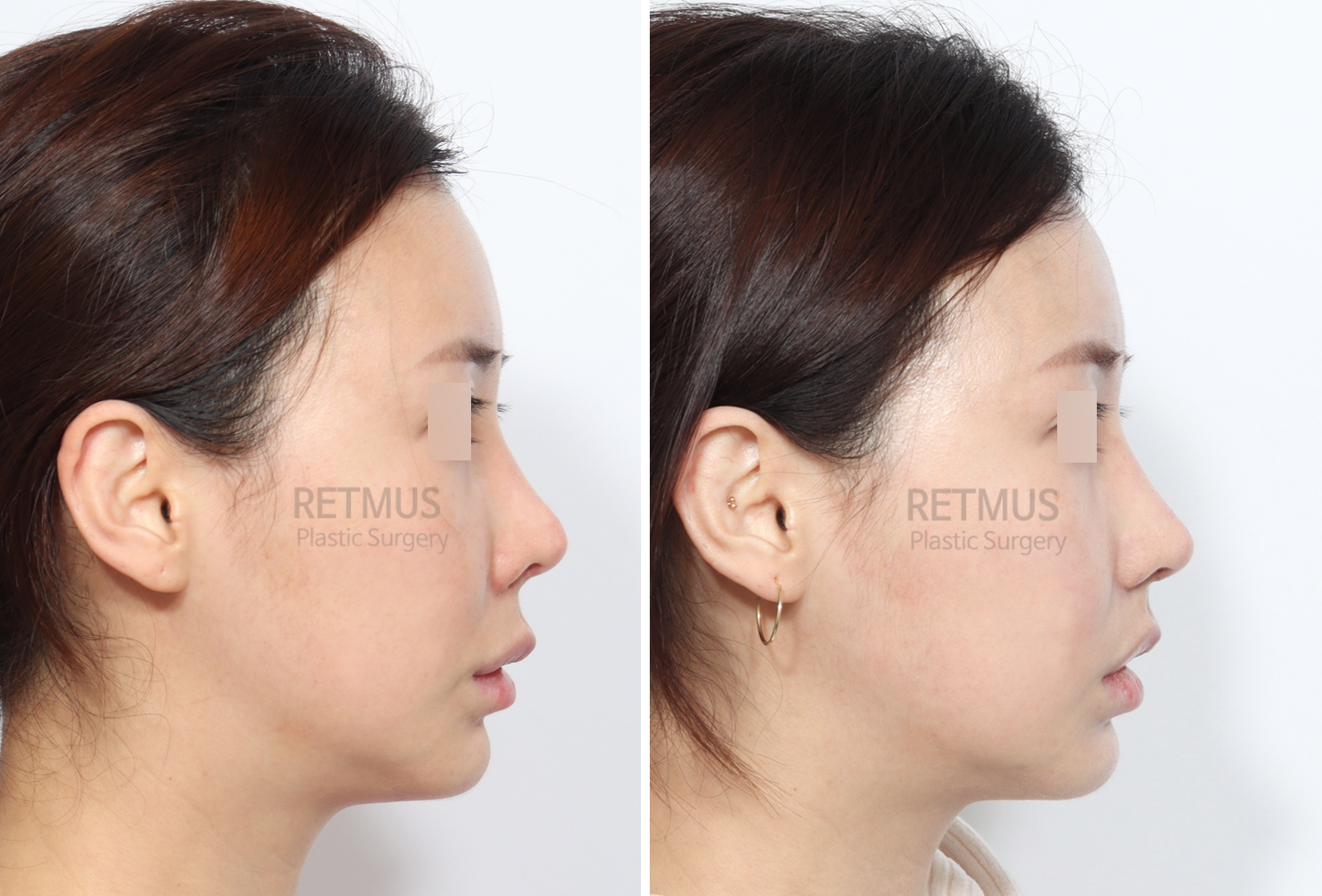 인중코 3개월차 [인중축소+코끝재수술] (upper lip lift + tip revision)