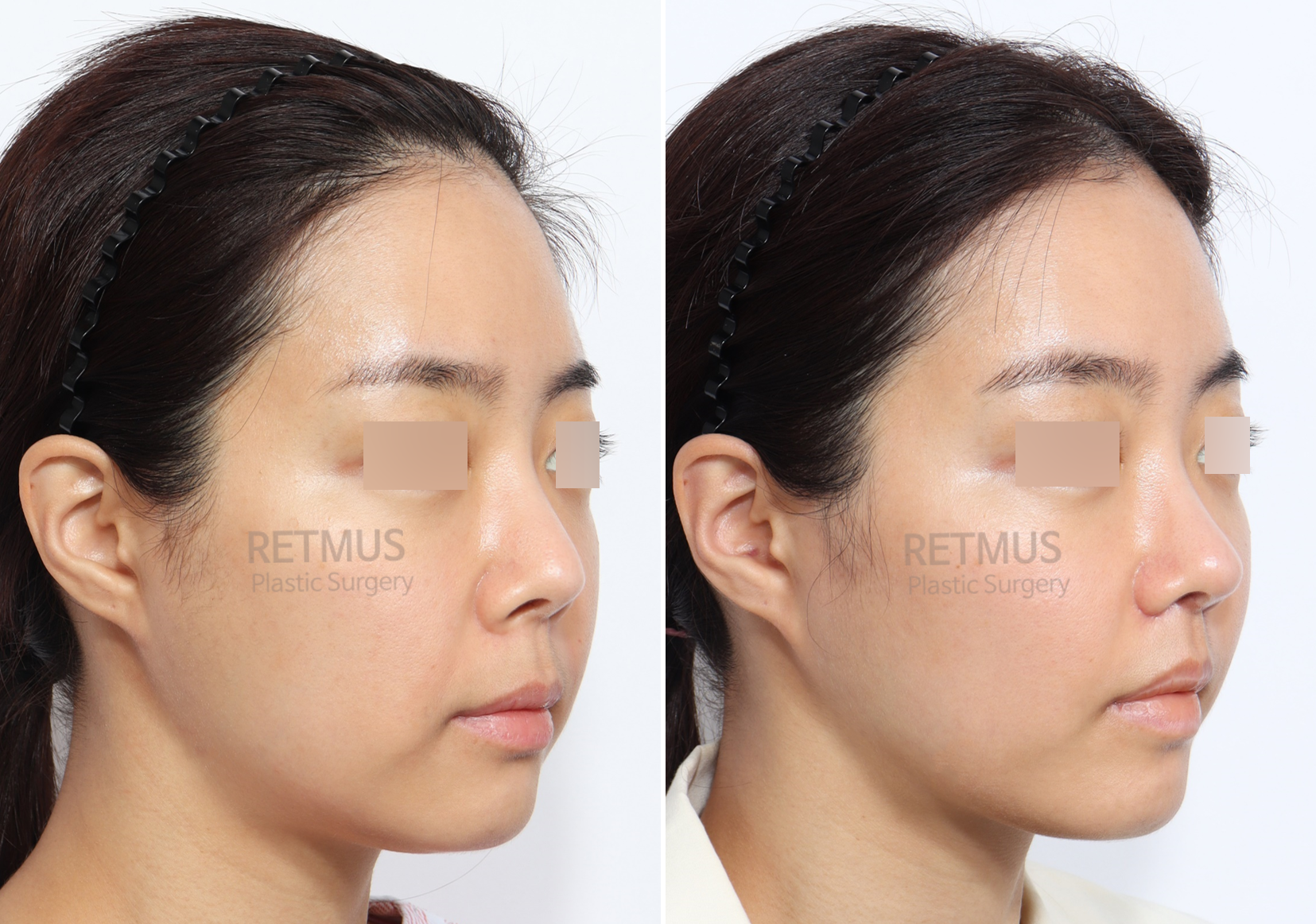인중코 2개월차 [인중축소+코끝재수술] (upper lip lift+ tip revision)