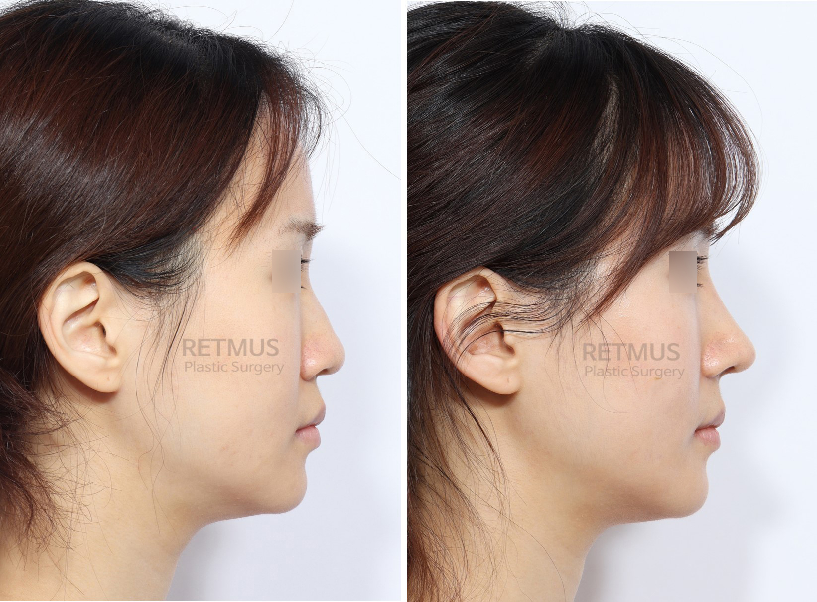 인중코 1개월차 [코성형+콧볼축소] (Rhinoplasty + alar reduction)