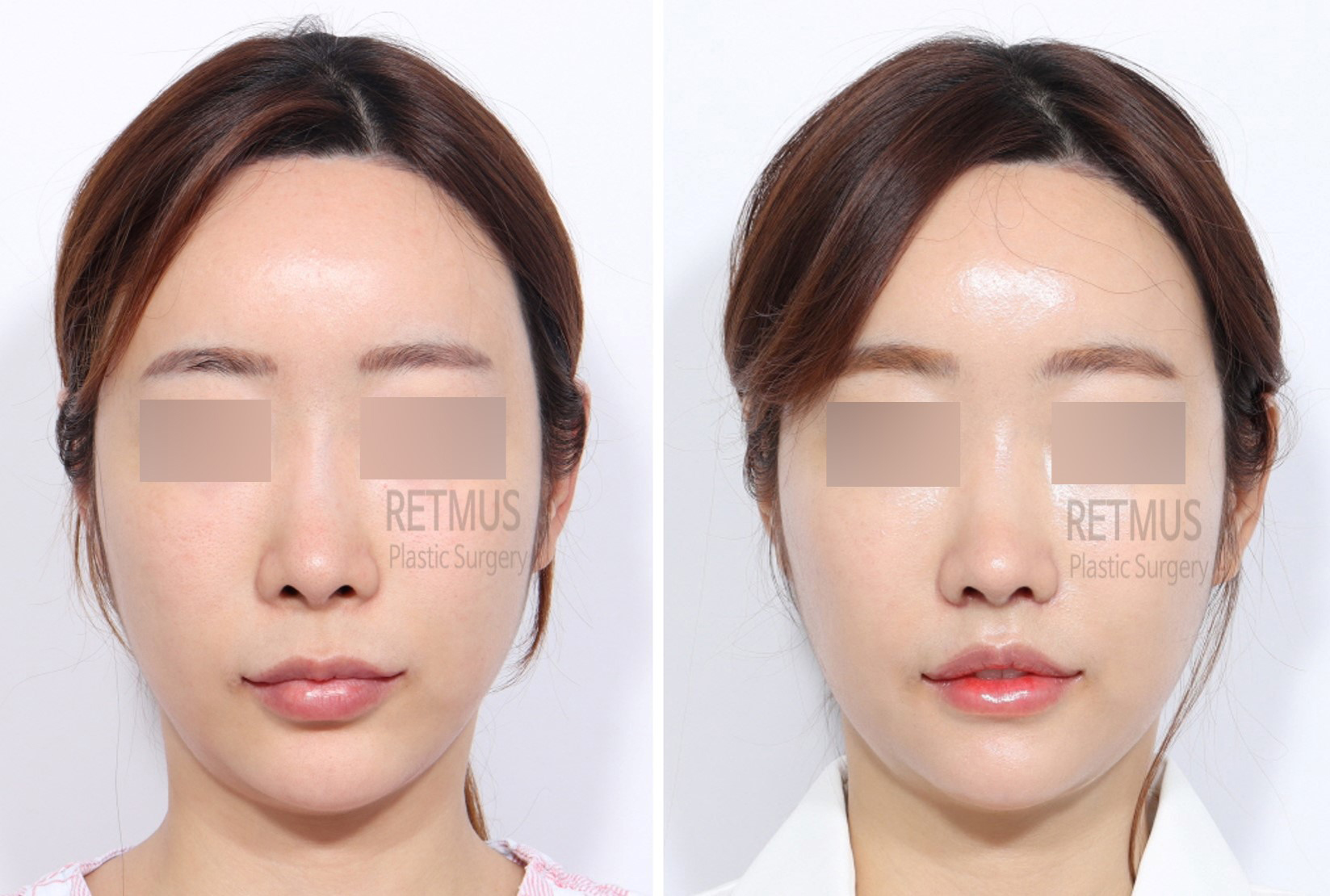 인중코 2주차 [인중축소+코끝재수술] (upper lip lift +alar + tip revision)