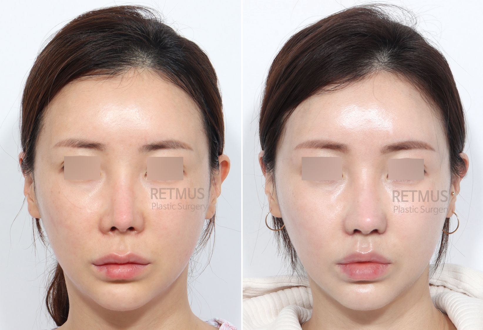 인중코 3개월차 [인중축소+코끝재수술] (upper lip lift + tip revision)