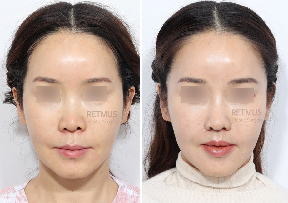 인중축소+매부리코성형 (upper lip lift + Rhinoplasty)