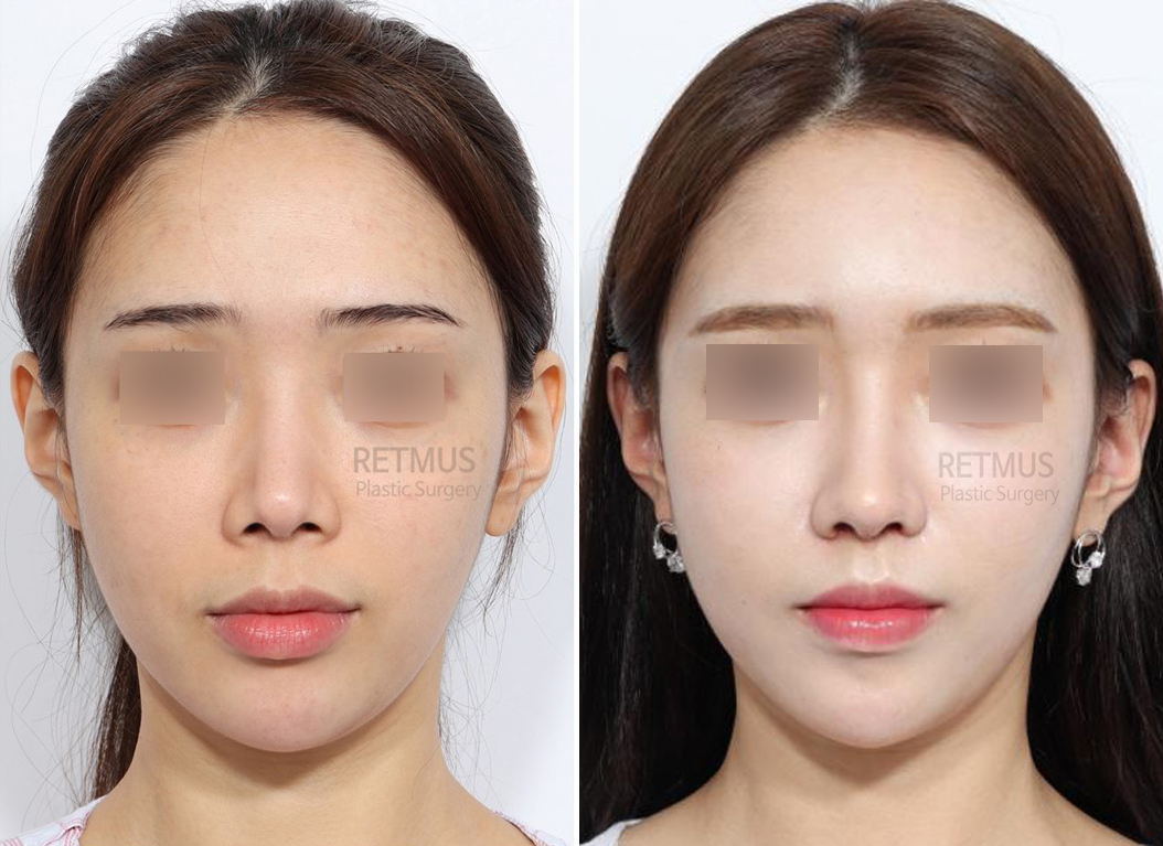 인중코 1개월차 [인중축소+코재수술] (upper lip lift + Revision Rhinoplasty)