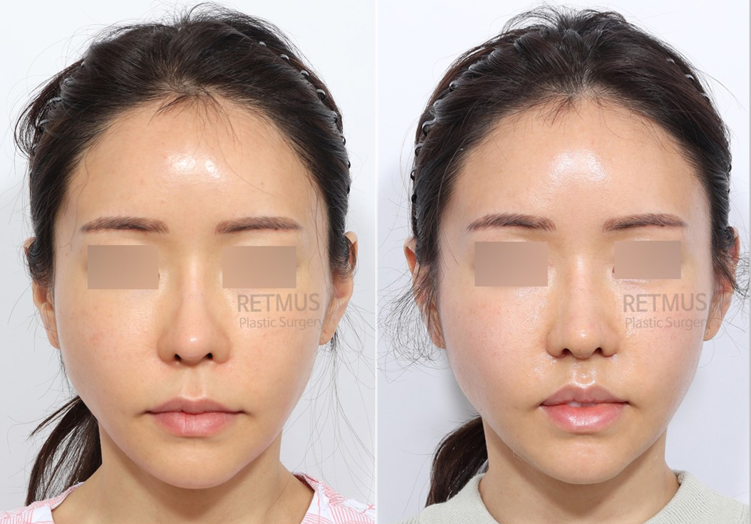 인중코 1주차 [인중축소+코끝재수술] (upper lip lift+ tip revision)