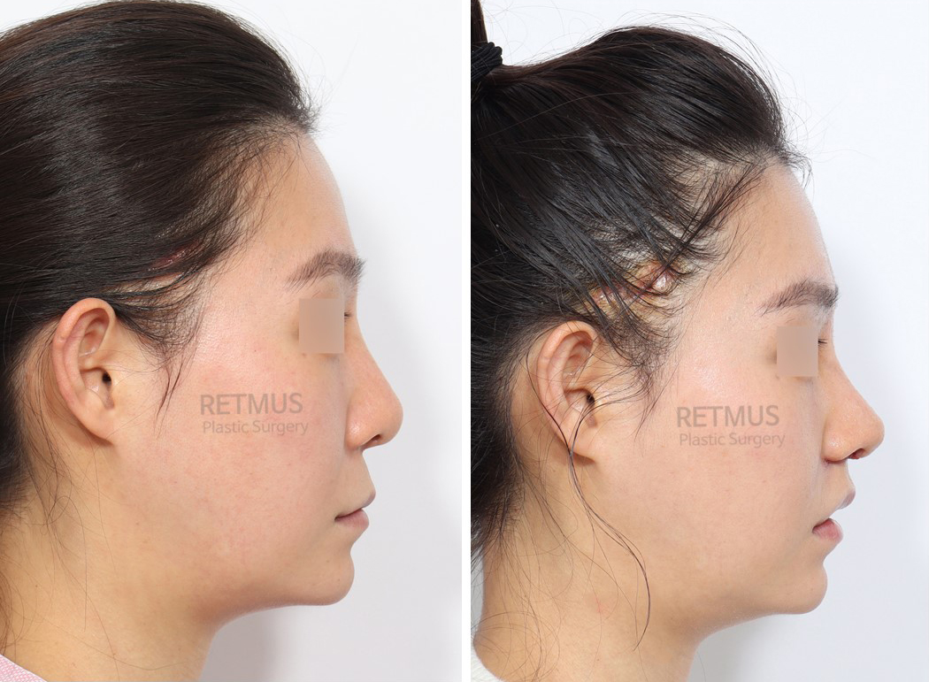 인중코 1주차 [인중축소+코재수술] (upper lip lift + Revision Rhinoplasty)