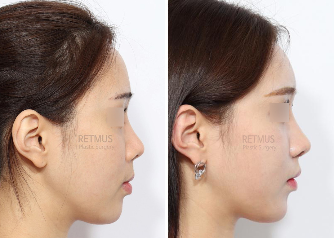 인중코 1개월차 [인중축소+코재수술] (upper lip lift + Revision Rhinoplasty)