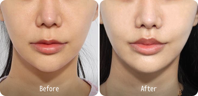 Upper lip lift