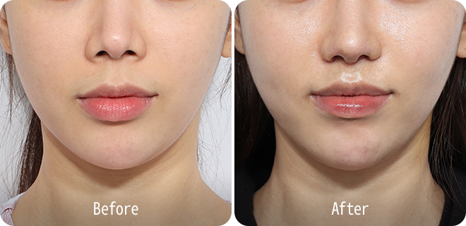 Upper lip lift