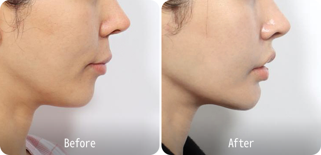 Upper lip lift