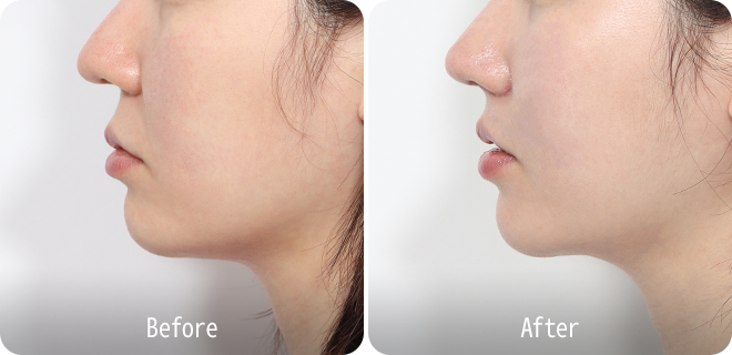 Upper lip lift