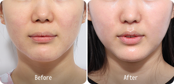 Upper lip lift