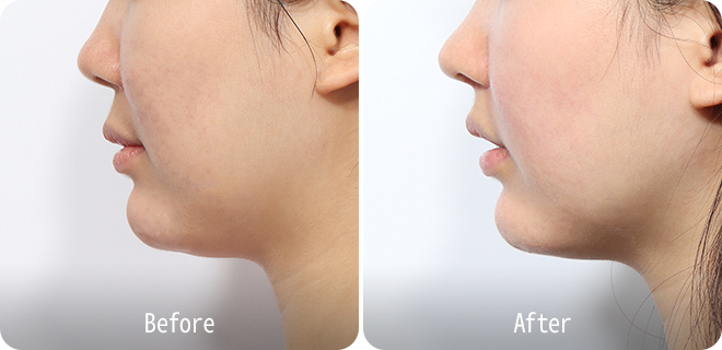 Upper lip lift